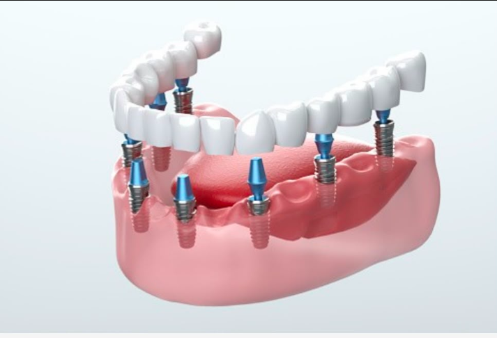 Implantologia dentale